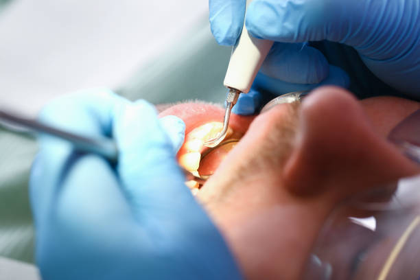 Best Emergency Gum Treatment in Fairview Heights, IL